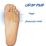 مورتون نوروما چیست و چطور درمان می‌شود؟